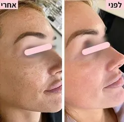 לפני ואחרי 4