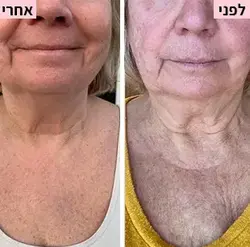 לפני ואחרי 2