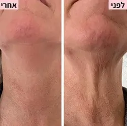 לפני ואחרי  1